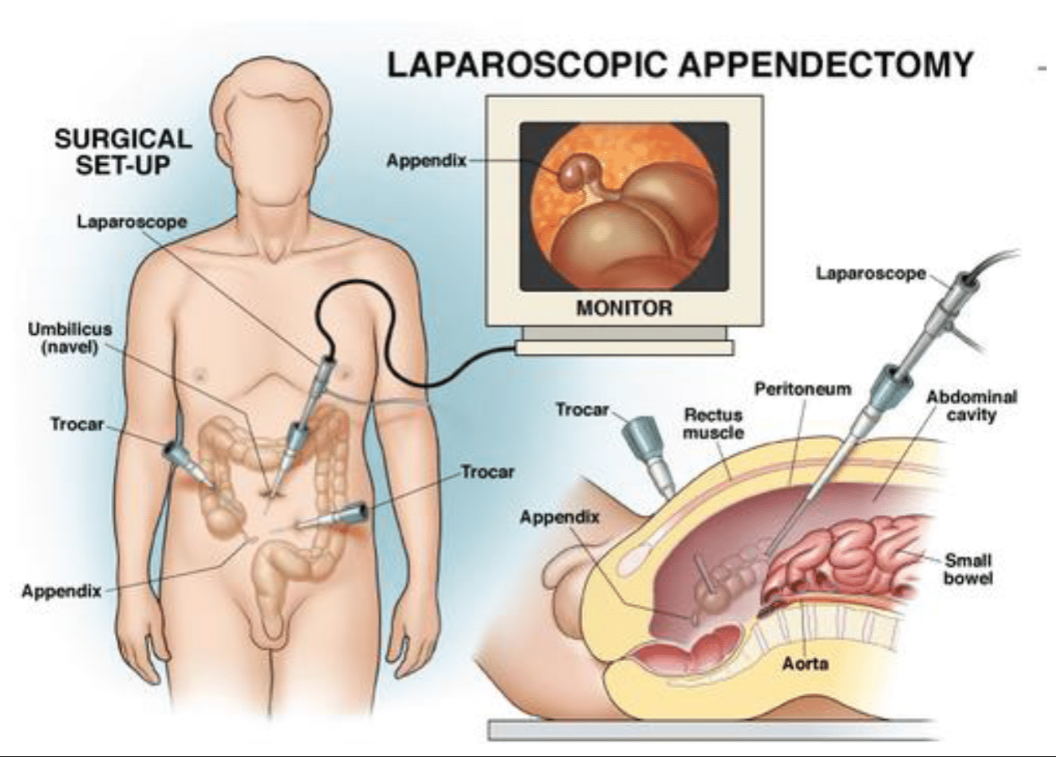 Appendix Surgery (Appendectomy)